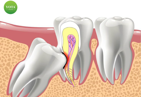 Nhổ răng khôn chảy máu bao lâu? Bao lâu thì lành?